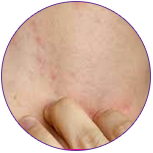 Treatment of inflammatory skin disorders